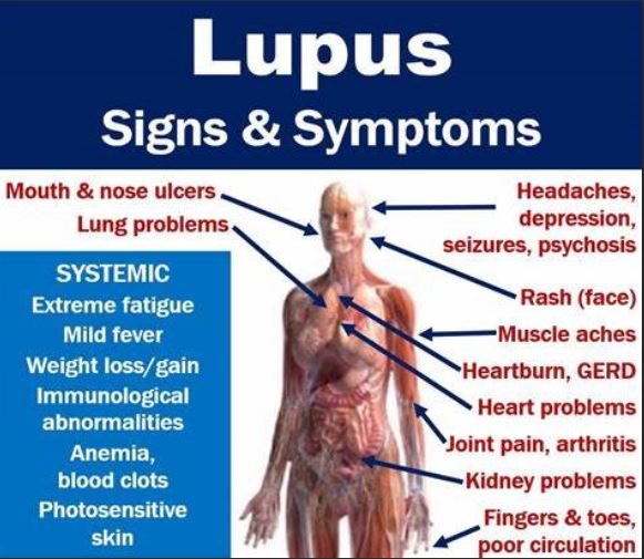 لوپوس و بیماری قلبی عروقی