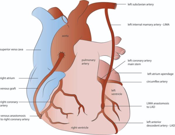 عمل جراحی پیوند رگ قلب