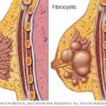 تغییرات فیبروکیستیک پستان